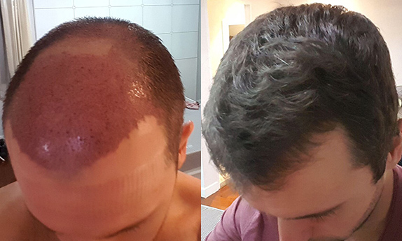 My FUT Hair Transplant: The First 5 Months | Finch Sells